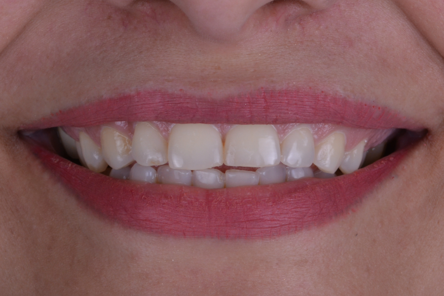 قبل تغير لون و شكل الأسنان لإعادة تأهيل الابتسامة.